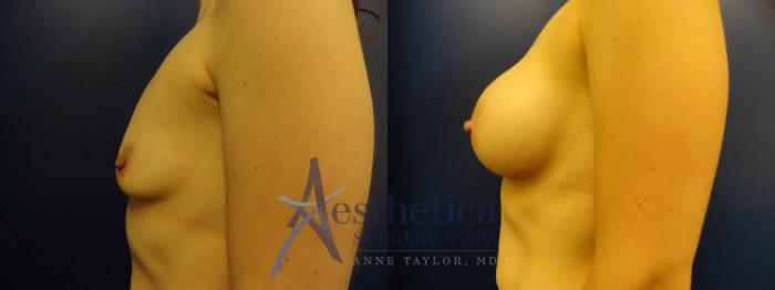 Breast Augmentation Case 182 Before & After View #3 | Columbus, OH | Aesthetica Surgery & Spa