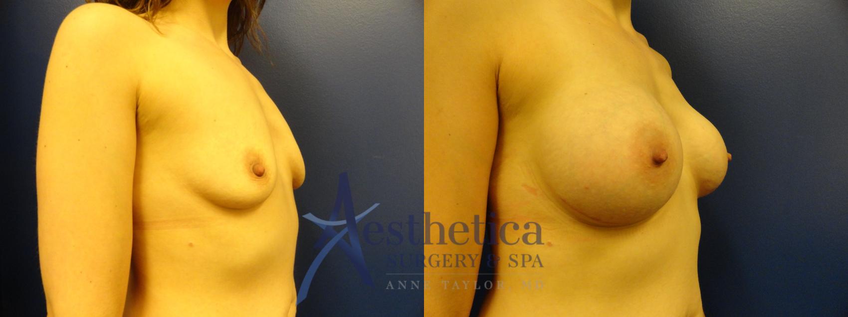 Breast Augmentation Case 182 Before & After View #4 | Worthington, OH | Aesthetica Surgery & Spa