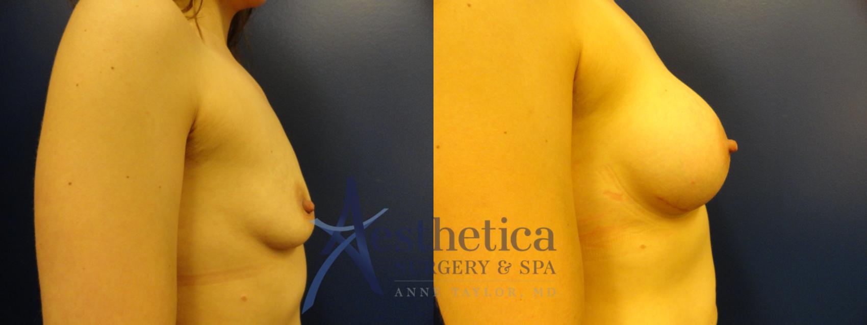 Breast Augmentation Case 182 Before & After View #5 | Worthington, OH | Aesthetica Surgery & Spa