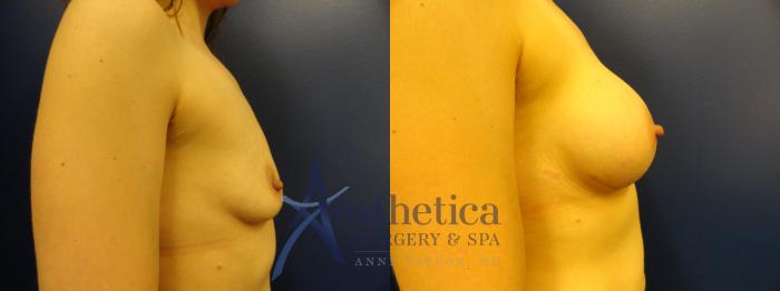 Breast Augmentation Case 182 Before & After View #5 | Columbus, OH | Aesthetica Surgery & Spa