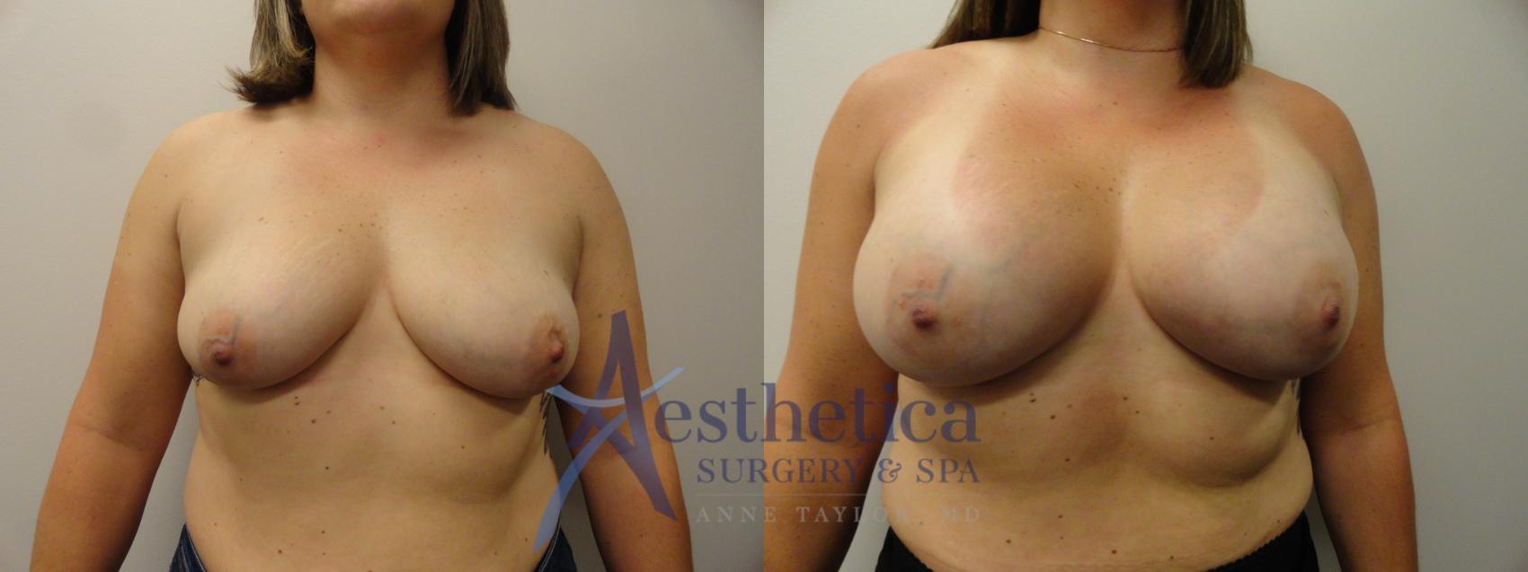 Breast Augmentation Case 269 Before & After View #1 | Worthington, OH | Aesthetica Surgery & Spa