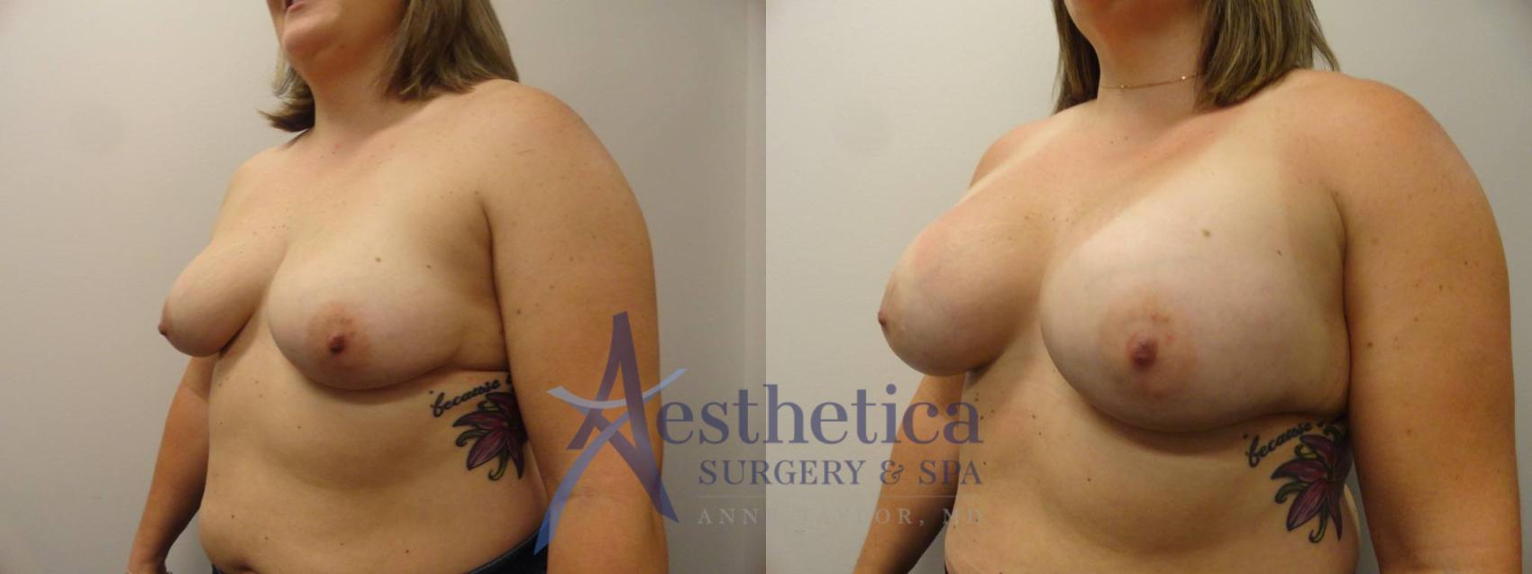 Breast Augmentation Case 269 Before & After View #2 | Worthington, OH | Aesthetica Surgery & Spa