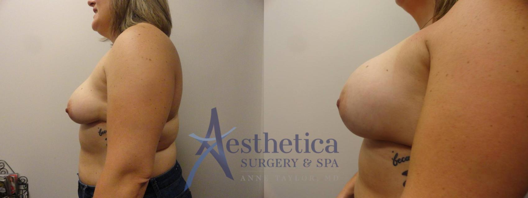 Breast Augmentation Case 269 Before & After View #3 | Worthington, OH | Aesthetica Surgery & Spa