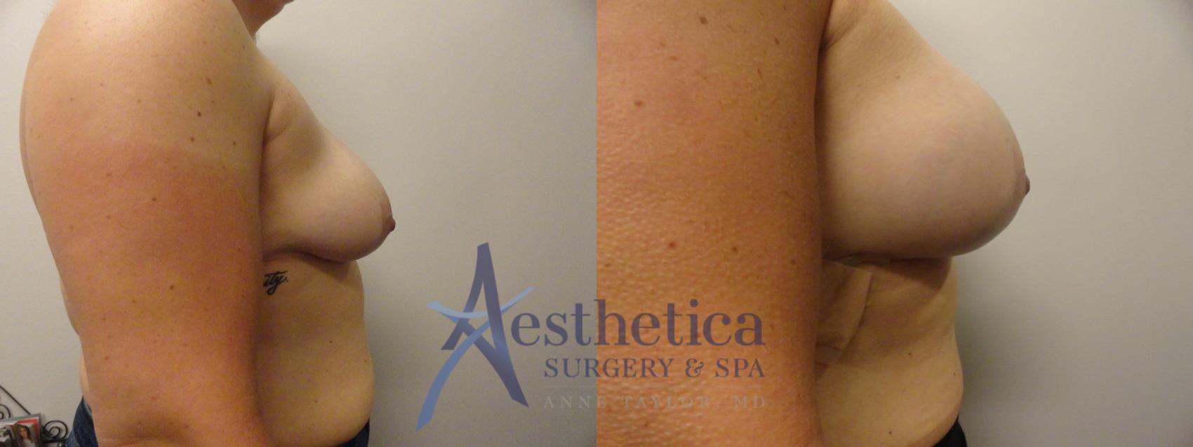 Breast Augmentation Case 269 Before & After View #5 | Worthington, OH | Aesthetica Surgery & Spa