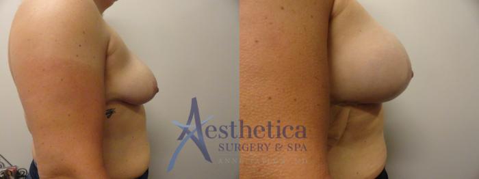 Breast Augmentation Case 269 Before & After View #5 | Columbus, OH | Aesthetica Surgery & Spa
