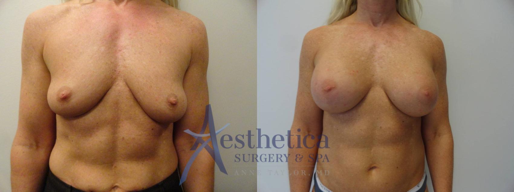 Breast Augmentation Case 270 Before & After View #1 | Columbus, OH | Aesthetica Surgery & Spa