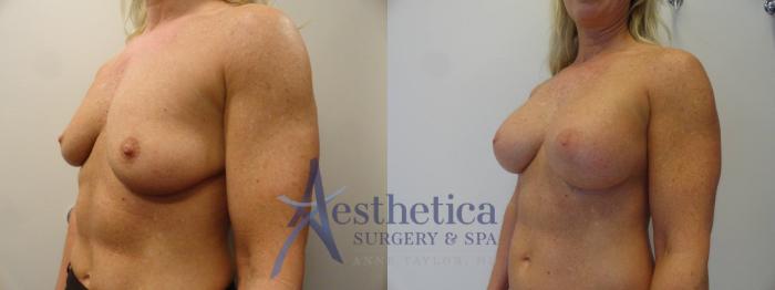 Breast Augmentation Case 270 Before & After View #2 | Columbus, OH | Aesthetica Surgery & Spa