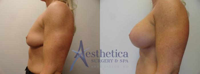 Breast Augmentation Case 270 Before & After View #3 | Columbus, OH | Aesthetica Surgery & Spa