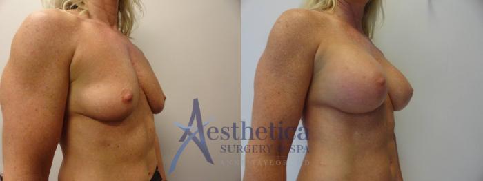 Breast Augmentation Case 270 Before & After View #4 | Columbus, OH | Aesthetica Surgery & Spa