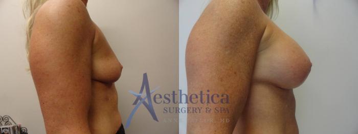 Breast Augmentation Case 270 Before & After View #5 | Columbus, OH | Aesthetica Surgery & Spa