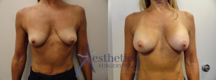 Breast Augmentation Case 271 Before & After View #1 | Columbus, OH | Aesthetica Surgery & Spa