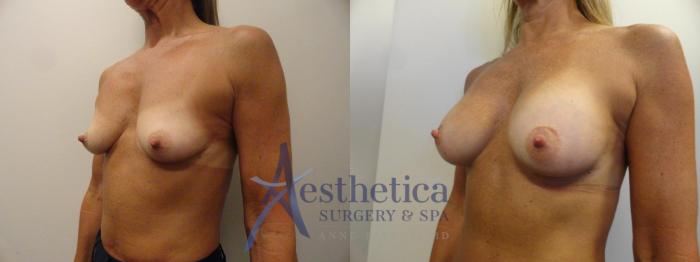 Breast Augmentation Case 271 Before & After View #2 | Columbus, OH | Aesthetica Surgery & Spa