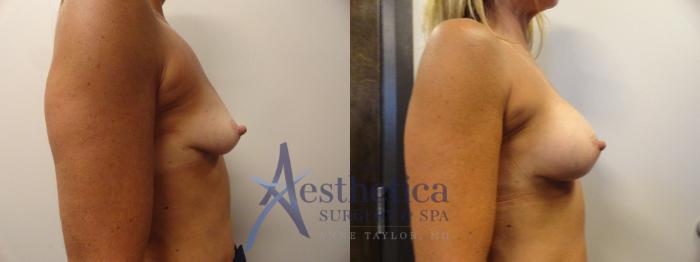 Breast Augmentation Case 271 Before & After View #3 | Columbus, OH | Aesthetica Surgery & Spa