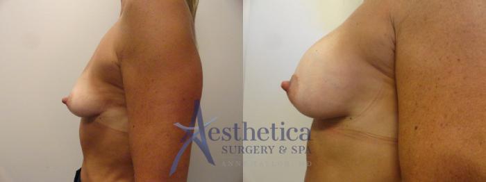 Breast Augmentation Case 271 Before & After View #5 | Columbus, OH | Aesthetica Surgery & Spa