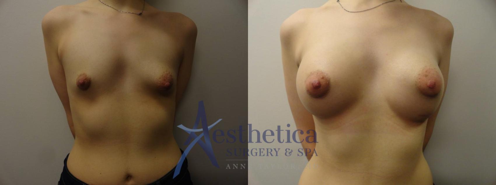 Breast Augmentation Case 272 Before & After View #1 | Columbus, OH | Aesthetica Surgery & Spa