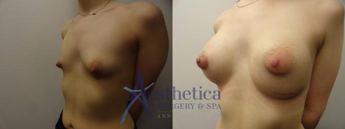 Breast Augmentation Case 272 Before & After View #2 | Columbus, OH | Aesthetica Surgery & Spa