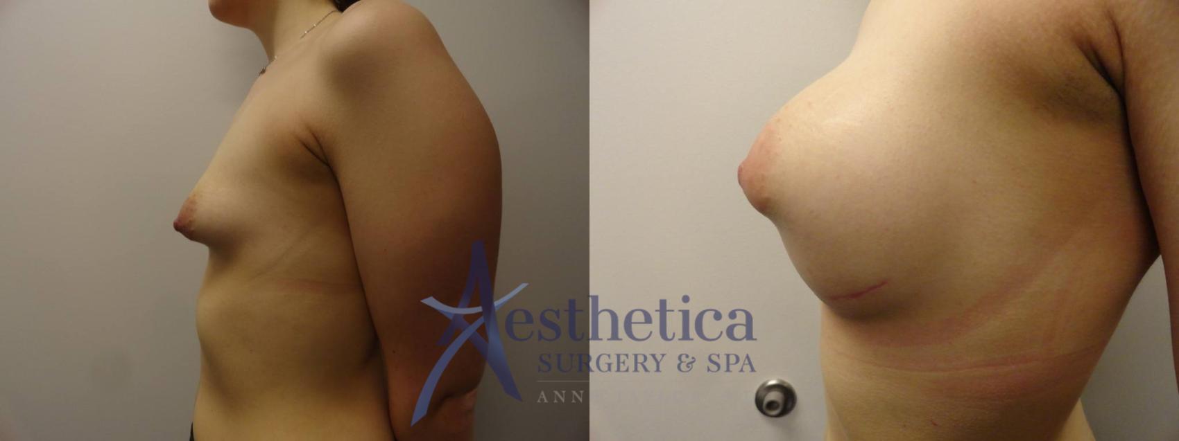 Breast Augmentation Case 272 Before & After View #3 | Columbus, OH | Aesthetica Surgery & Spa