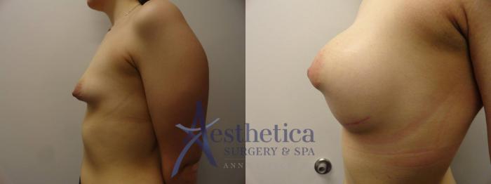 Breast Augmentation Case 272 Before & After View #3 | Columbus, OH | Aesthetica Surgery & Spa