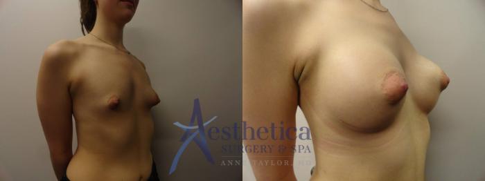 Breast Augmentation Case 272 Before & After View #4 | Columbus, OH | Aesthetica Surgery & Spa