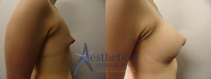 Breast Augmentation Case 272 Before & After View #5 | Columbus, OH | Aesthetica Surgery & Spa