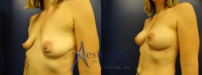 Breast Augmentation Case 276 Before & After View #2 | Columbus, OH | Aesthetica Surgery & Spa