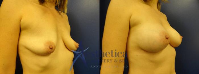 Breast Augmentation Case 276 Before & After View #4 | Columbus, OH | Aesthetica Surgery & Spa