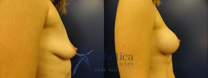 Breast Augmentation Case 276 Before & After View #5 | Columbus, OH | Aesthetica Surgery & Spa