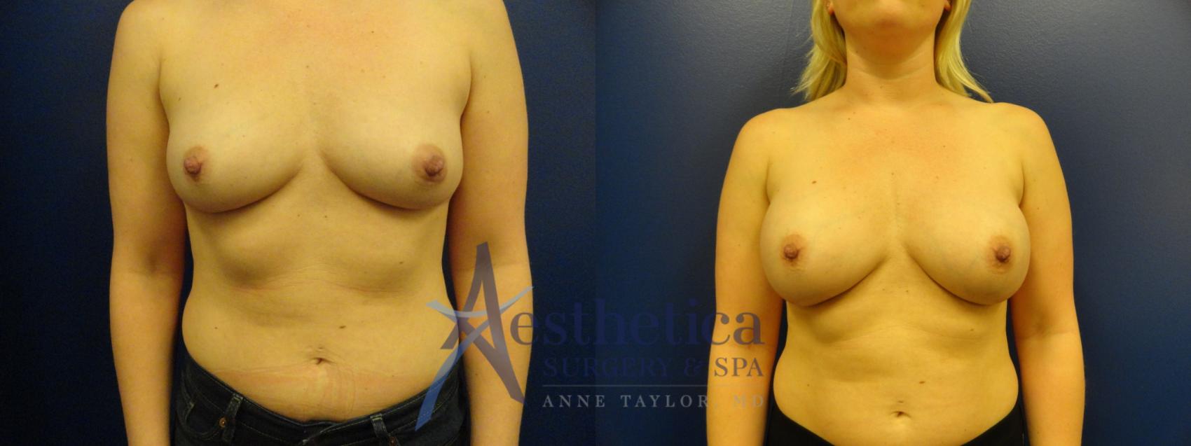 Breast Augmentation Case 28 Before & After View #1 | Worthington, OH | Aesthetica Surgery & Spa
