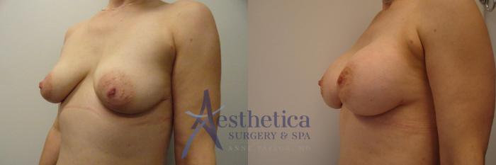 Breast Augmentation Case 284 Before & After View #2 | Columbus, OH | Aesthetica Surgery & Spa