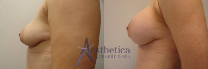 Breast Augmentation Case 284 Before & After View #3 | Columbus, OH | Aesthetica Surgery & Spa