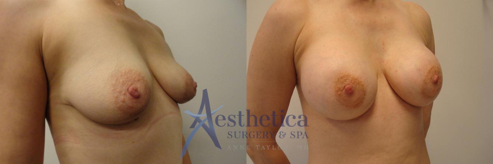 Breast Augmentation Case 284 Before & After View #4 | Columbus, OH | Aesthetica Surgery & Spa