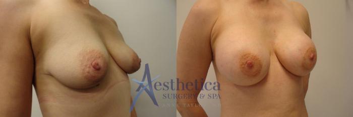 Breast Augmentation Case 284 Before & After View #4 | Columbus, OH | Aesthetica Surgery & Spa