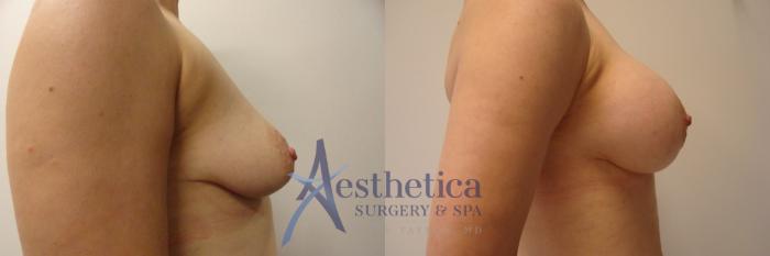 Breast Augmentation Case 284 Before & After View #5 | Columbus, OH | Aesthetica Surgery & Spa