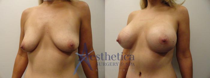 Breast Augmentation Case 295 Before & After View #2 | Columbus, OH | Aesthetica Surgery & Spa
