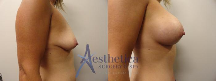 Breast Augmentation Case 295 Before & After View #5 | Columbus, OH | Aesthetica Surgery & Spa