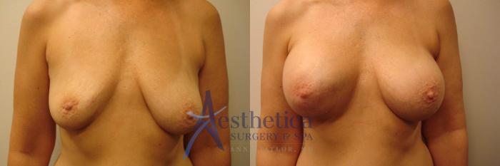 Breast Augmentation Case 319 Before & After View #1 | Columbus, OH | Aesthetica Surgery & Spa