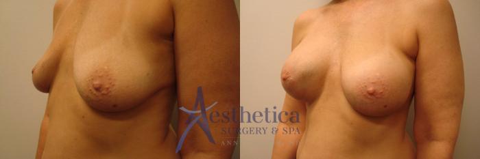 Breast Augmentation Case 319 Before & After View #2 | Columbus, OH | Aesthetica Surgery & Spa