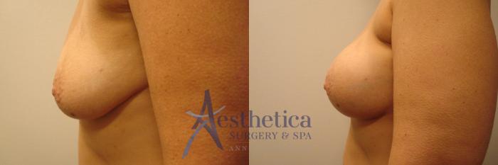 Breast Augmentation Case 319 Before & After View #3 | Columbus, OH | Aesthetica Surgery & Spa