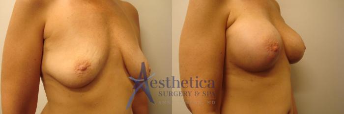 Breast Augmentation Case 319 Before & After View #4 | Columbus, OH | Aesthetica Surgery & Spa