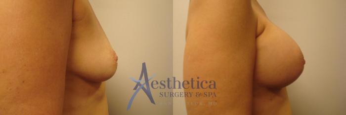 Breast Augmentation Case 319 Before & After View #5 | Columbus, OH | Aesthetica Surgery & Spa