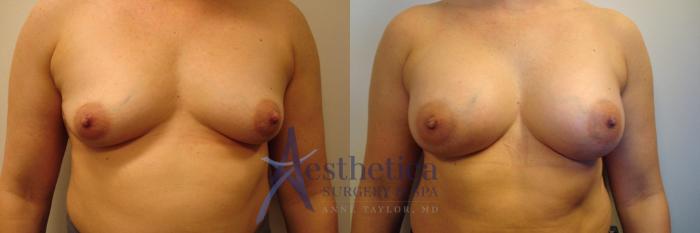 Breast Augmentation Case 322 Before & After View #1 | Columbus, OH | Aesthetica Surgery & Spa