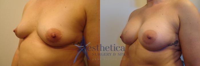 Breast Augmentation Case 322 Before & After View #2 | Columbus, OH | Aesthetica Surgery & Spa