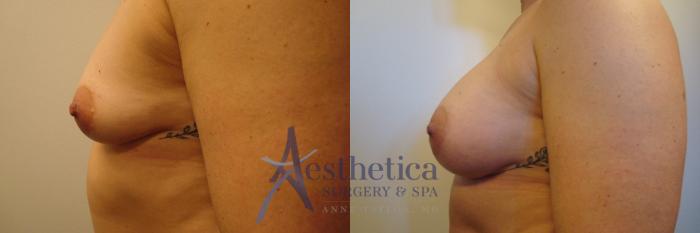 Breast Augmentation Case 322 Before & After View #3 | Columbus, OH | Aesthetica Surgery & Spa