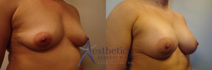 Breast Augmentation Case 322 Before & After View #4 | Columbus, OH | Aesthetica Surgery & Spa