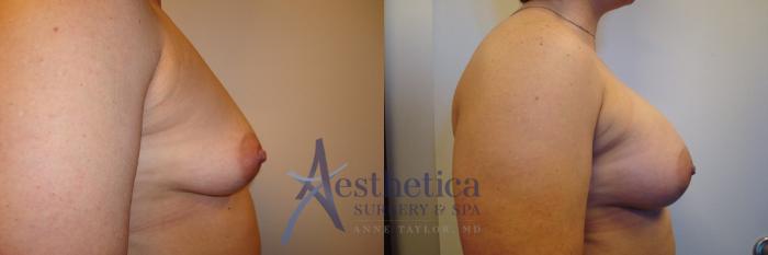 Breast Augmentation Case 322 Before & After View #5 | Columbus, OH | Aesthetica Surgery & Spa