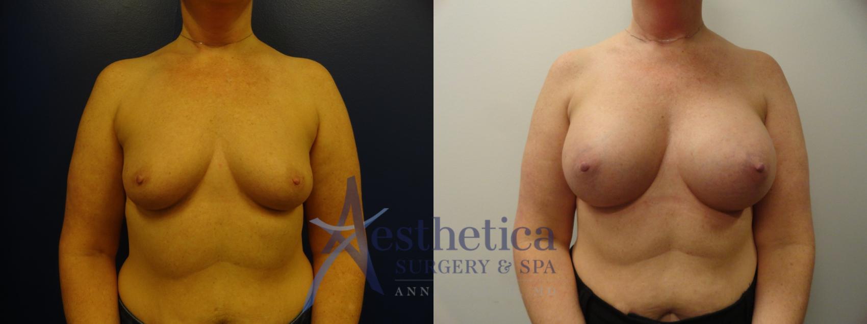 Breast Augmentation Case 327 Before & After View #1 | Columbus, OH | Aesthetica Surgery & Spa