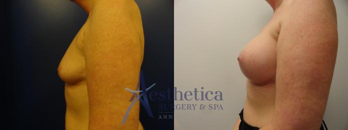 Breast Augmentation Case 327 Before & After View #2 | Columbus, OH | Aesthetica Surgery & Spa