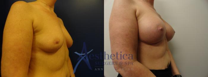 Breast Augmentation Case 327 Before & After View #3 | Columbus, OH | Aesthetica Surgery & Spa
