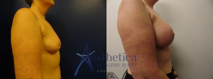Breast Augmentation Case 327 Before & After View #4 | Columbus, OH | Aesthetica Surgery & Spa