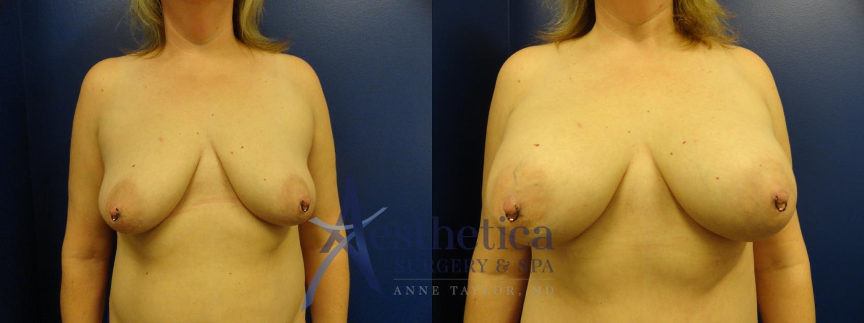 Breast Augmentation Case 328 Before & After View #1 | Columbus, OH | Aesthetica Surgery & Spa